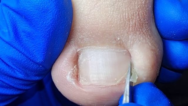 Ingrown Pedicure, A Lot Of Nails Hidden In The Flesh Of The Toe【Xue Yidao Pedicure】