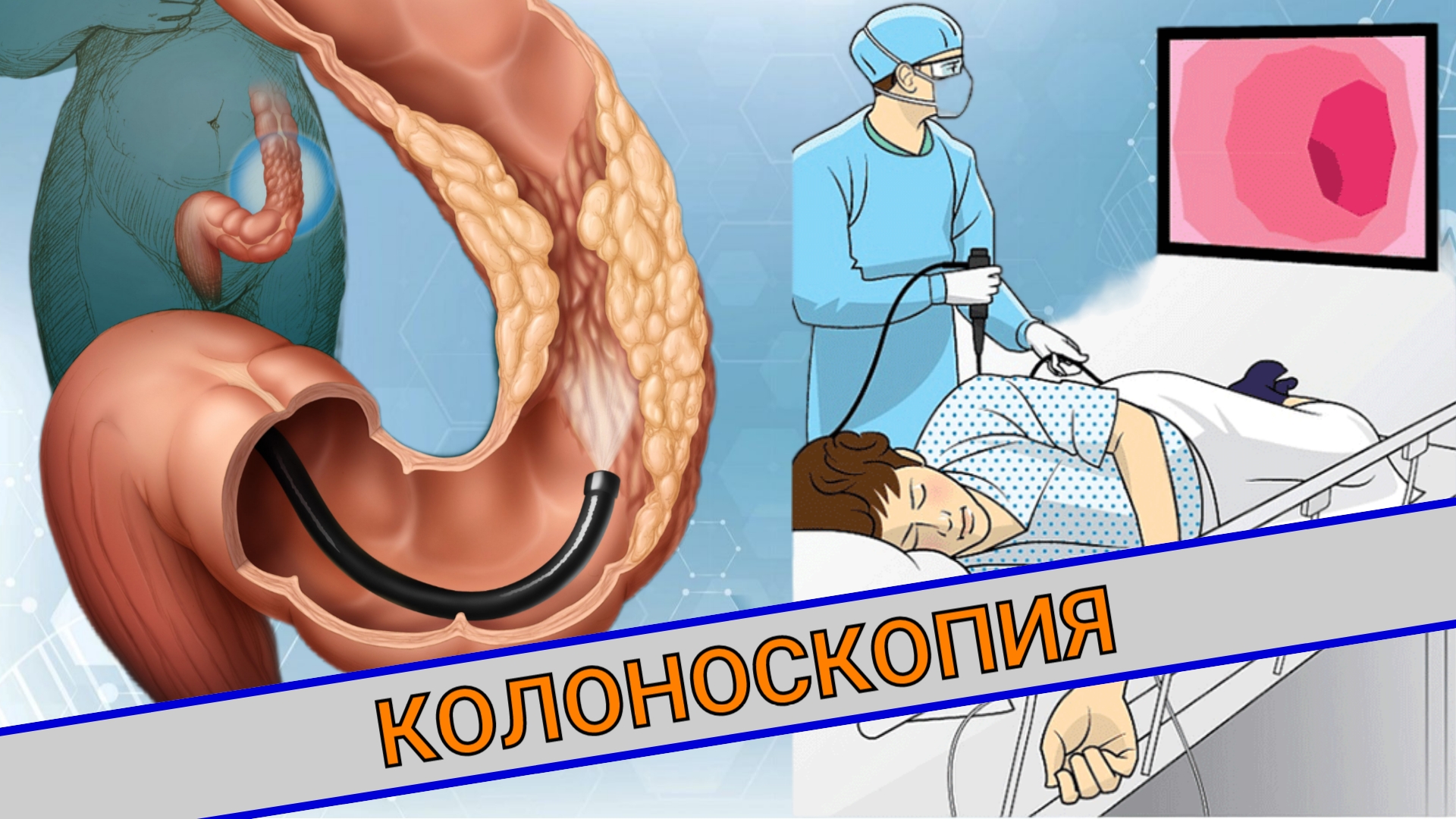 КОЛОНОСКОПИЯ || ЧТО ЭТО? КАК ПОДГОТОВИТЬСЯ? смотреть онлайн