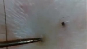 УДАЛЕНИЕ ВРОСШИХ ВОЛОС