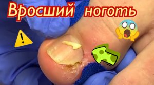 Вросший ноготь??