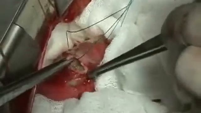 Эхинококк в сердце смотреть онлайн