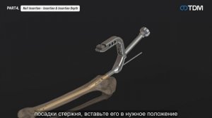 Штифт для большеберцовой кости