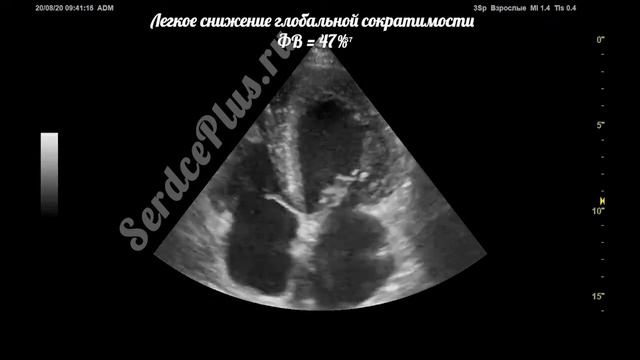 ЭхоКГ. Определение фракции выброса левого желудочка. Глобальная сократимость ЛЖ. смотреть онлайн