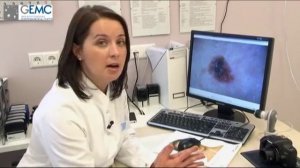 Меланома: ранняя диагностика!