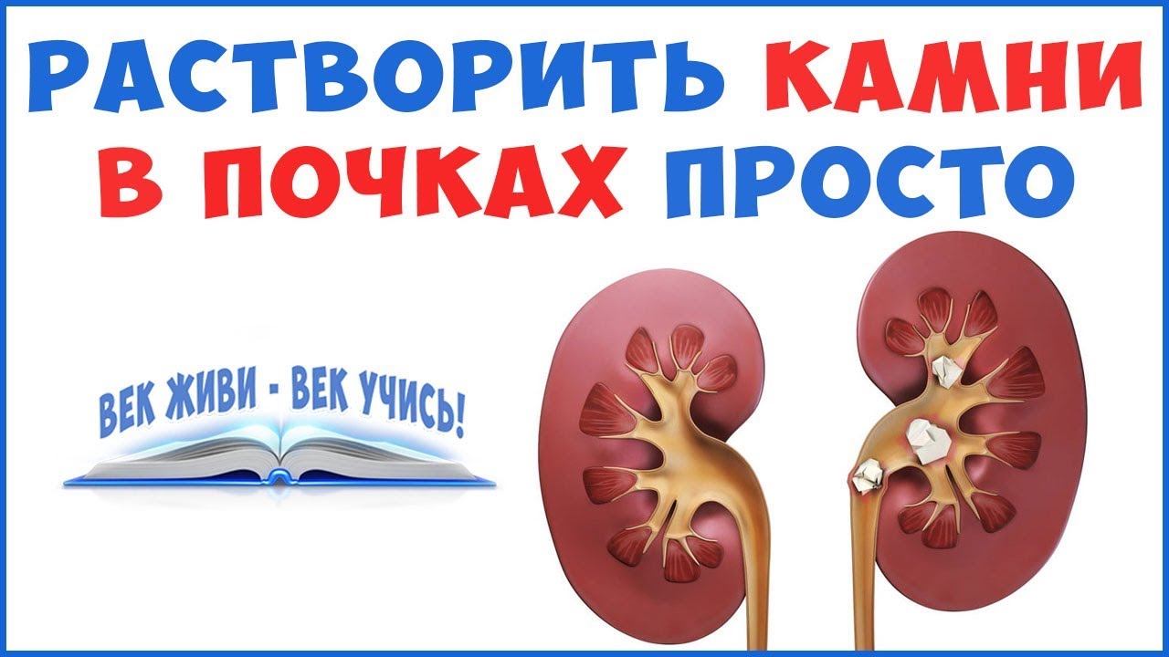 Как растворить Камни в ПОЧКАХ без операции и дробления! смотреть онлайн