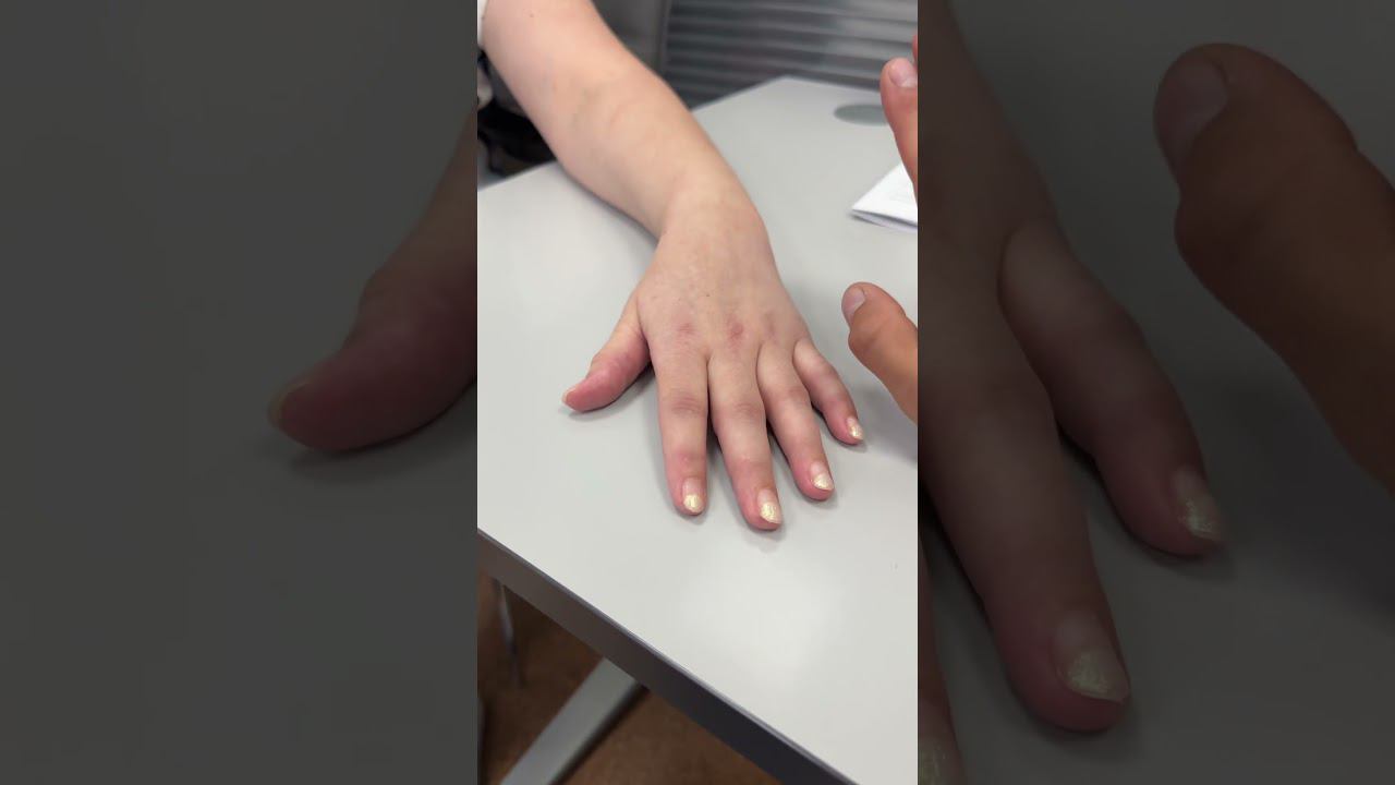 ЧТО С РУКОЙ ЧЕРЕЗ 80 дней ГИПСА | Доктор Юршин смотреть онлайн