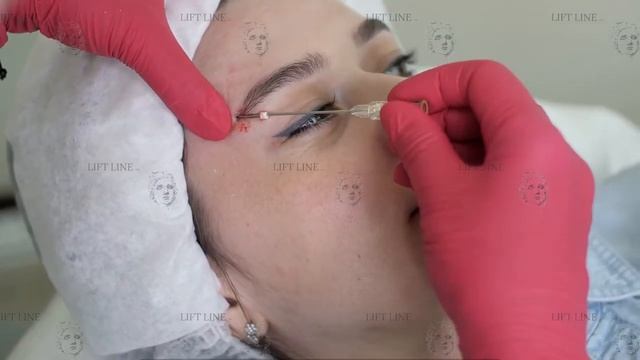 Лифтинг верхнего века нитями Lift Line Nata. Эффект "лисьи глазки" смотреть онлайн