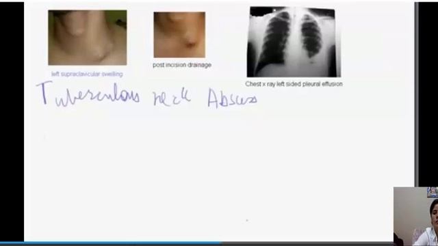 tuberculous смотреть онлайн