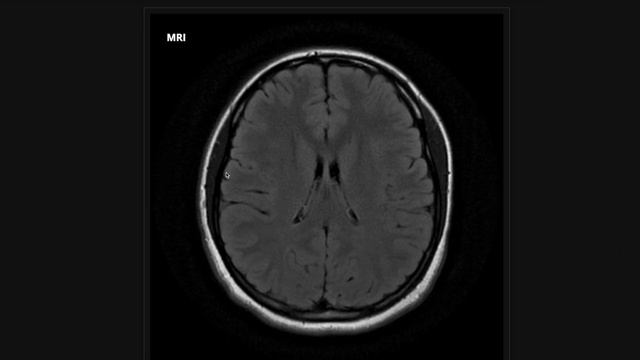 How to Read a Brain MRI: Basic Search Pattern & Sequences Explained смотреть онлайн