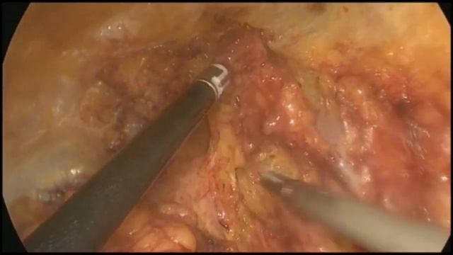 Asvide: Surgical technique of video-endoscopic radical inguinal lymph node dissection смотреть онлайн