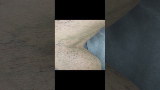 Склеротерапия сосулистой сетки. Как лечить варикоз? Лечение вен. Флеболог Москва. Флеболог смотреть онлайн