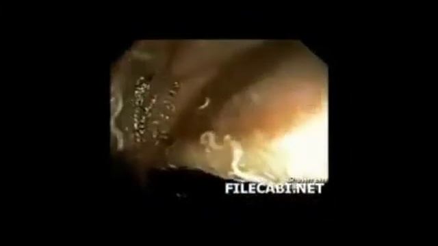 ЗАШЛАКОВАННОСТЬ ОРГАНИЗМА КИШЕЧНИКА РЕЗУЛЬТАТЫ смотреть онлайн