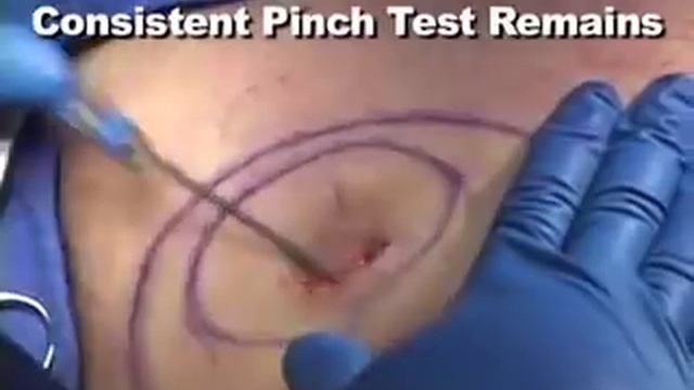 Gynecomastia Surgery Video (Graphic) Operating Room Movie смотреть онлайн