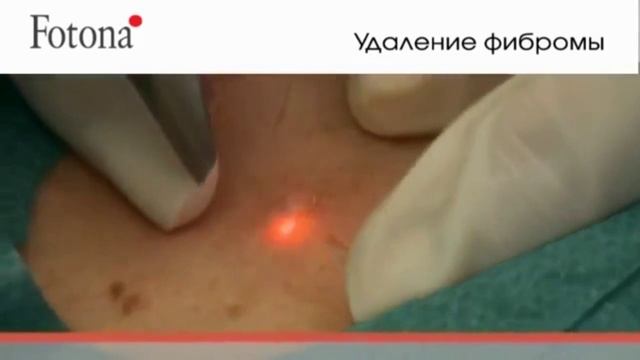 Лазерное удаление родинок в Резиденции Красоты 