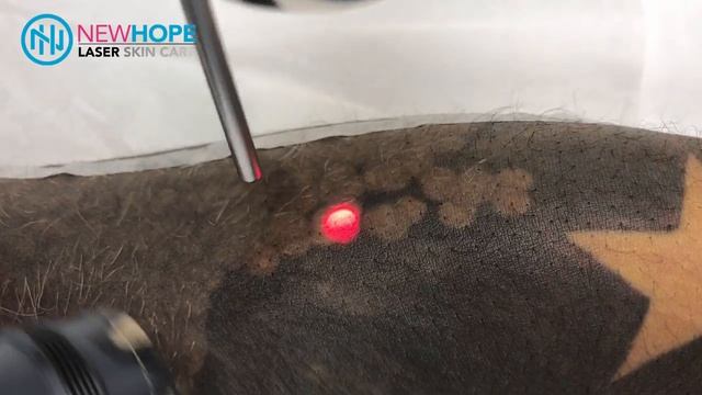 Laser Tattoo Removal - Removing Half Sleeve Tattoo - Newhope Laser Skin Care - Orange County смотреть онлайн