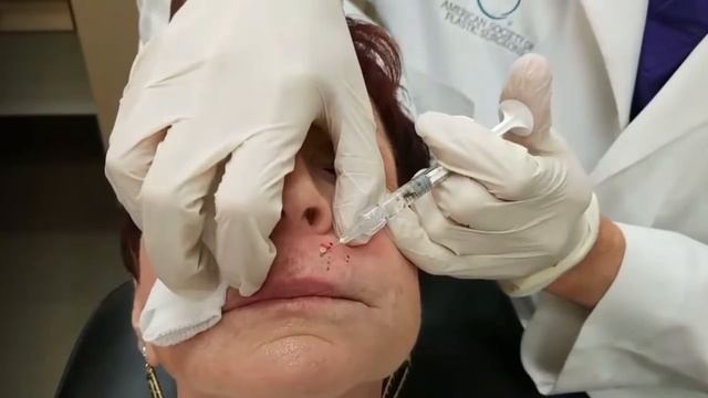 Belotero Injection смотреть онлайн