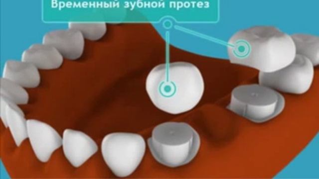 Мостовидные протезы смотреть онлайн