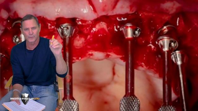 Dental Implants for Missing Teeth? Screw Your Dentist-How to Save 20k Now - Brighter Image Lab .com смотреть онлайн