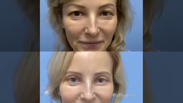 Верхняя и нижняя блефаропластика. Пластика век. смотреть онлайн