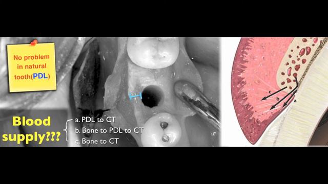 2B-3D Rule for Implant Position Part 2 смотреть онлайн