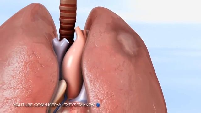 ТЭЛА. Тромбоэмболия легочной артерии. смотреть онлайн
