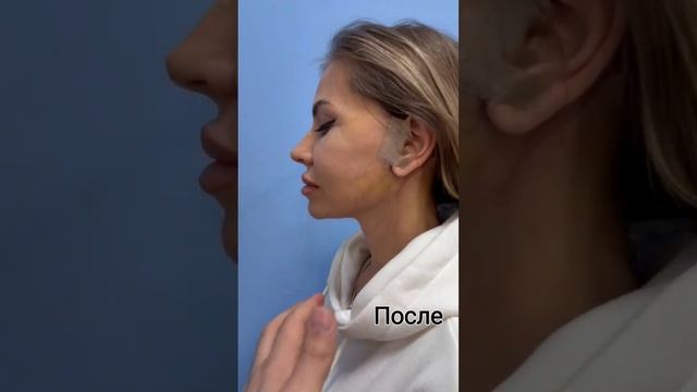 Подтяжка лица и шеи со смас лифтингом смотреть онлайн