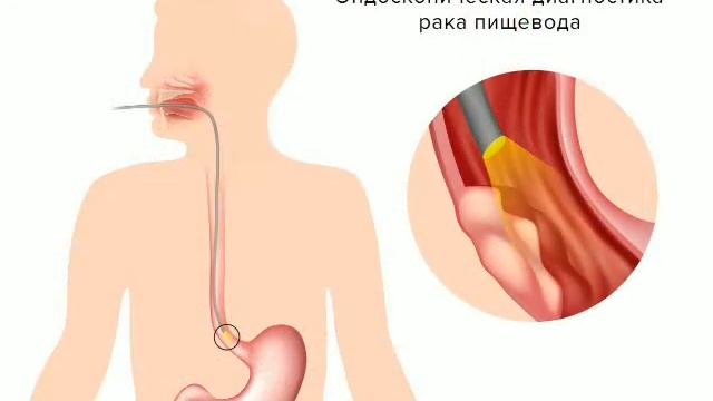 Рак пищевода и желудка Самандова Л 025 смотреть онлайн
