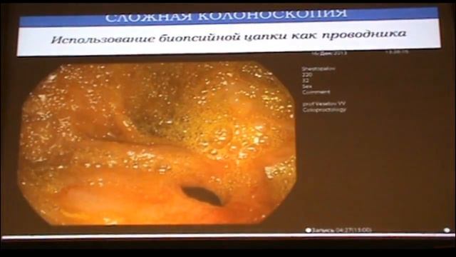 11 Веселов ВВ Сложная колоноскопия Способы и средства преодоления смотреть онлайн