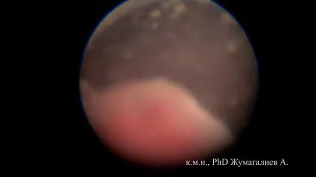 Контактная наноимпульсная литотрипсия смотреть онлайн