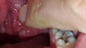 Удаление миндальных камней #8