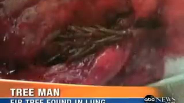 ABC News - Tree Grows Inside Man's Lung смотреть онлайн