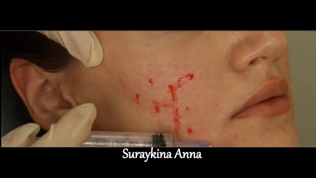 мезоботокс , лечение акне ,  мезотерапия , Mezobotoks ,  Mesotherapy , сурайкина анна