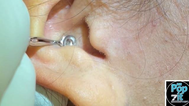 Blackheads in the ear. Ear extractions. Oily plugs extracted. Full face video coming soon. MrPopZit смотреть онлайн