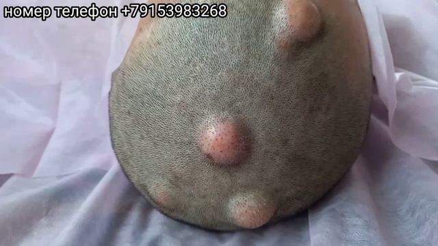 Жировик дар пусти Сар_ Жировики на коже Головы смотреть онлайн