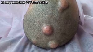 Жировик дар пусти Сар_ Жировики на коже Головы