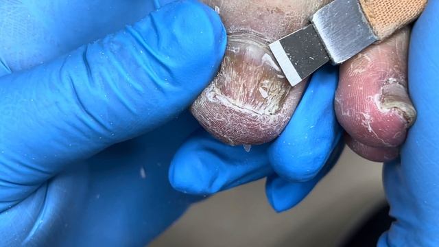 Pedicure Tutorial：very thick onychomycosis【Pedicure Master Lin Jun】 смотреть онлайн