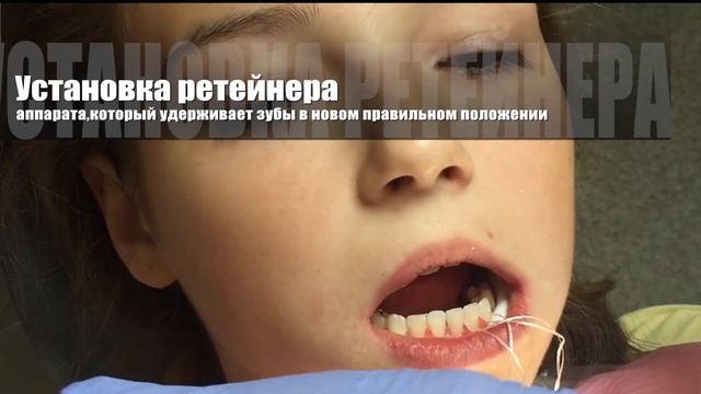 Брекеты!!Мы снимаем БРЕКЕТЫ!!! Как это?! Orthodontic debonding смотреть онлайн