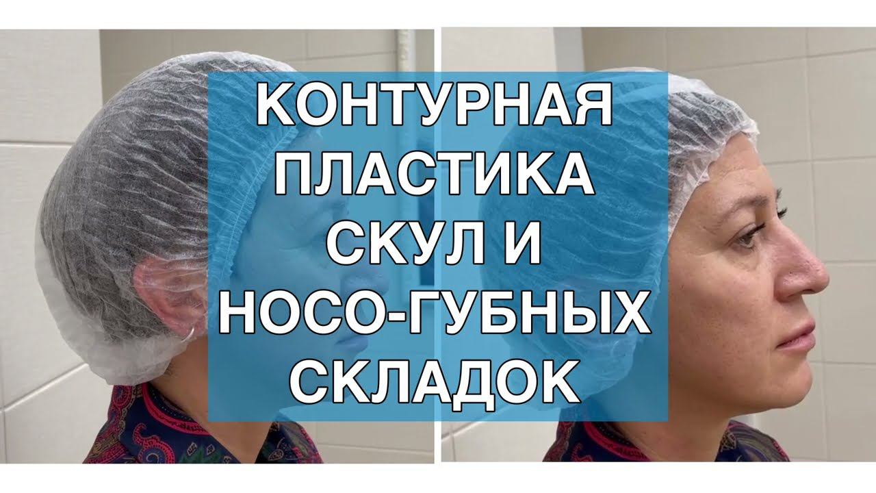 Контурная пластика скул и носо-губных складок в Курске смотреть онлайн