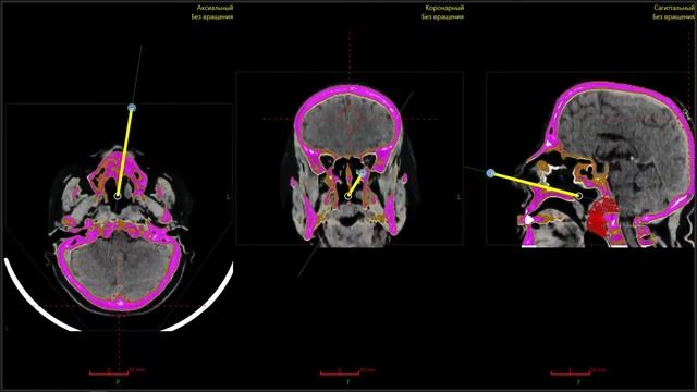 Запись с экрана монитора системы хирургической навигационной "МУЛЬТИТРЕК" смотреть онлайн