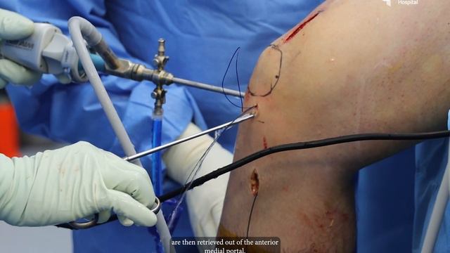 LIVE Surgery Explained: Anterior Cruciate Ligament (ACL) Reconstruction Surgery смотреть онлайн