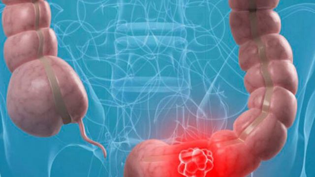 Признаки того что ваш ТОЛСТЫЙ КИШЕЧНИК ОТМИРАЕТ! Почему толстая кишка отмирает? смотреть онлайн