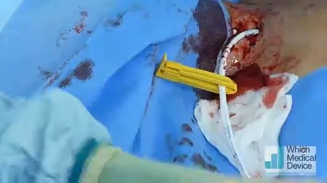Medcomp split stream dilaysis catheter insertion смотреть онлайн