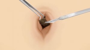 ASMR | Huge Navel Stone Removal Animation Collection