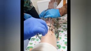 Как снимают спицы аппарата Илизарова со ступни. НА ЖИВУЮ, шок!!
