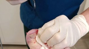 Лечение вросшего ногтя  Пластика околоногтевого валика с фиксацией пластырем