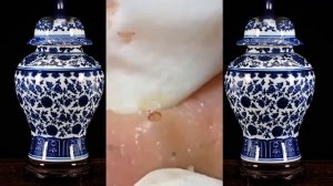 выдавливаю огромный прыщ!!!