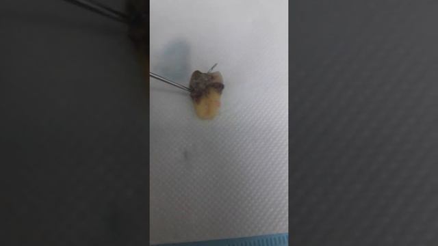 Плохой зуб мудрости