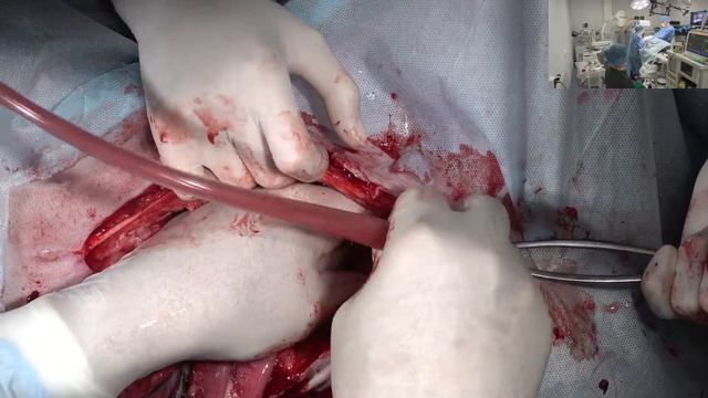 Новообразование брюшной полости. смотреть онлайн