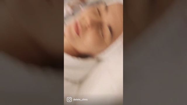 Лучшая процедура омоложения SMAS лифтинг в Delete смотреть онлайн