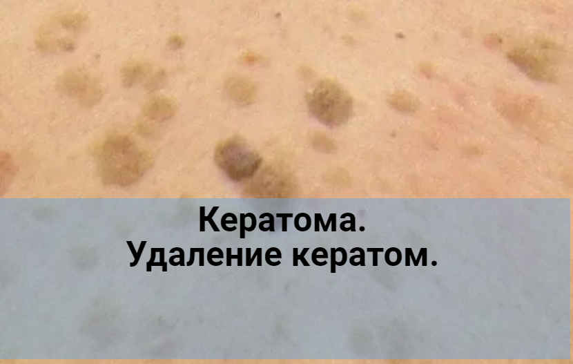 Кератома. Удаление кератом.